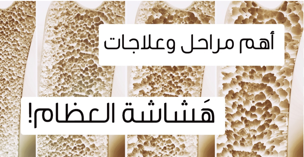 أسباب هشاشة العظام