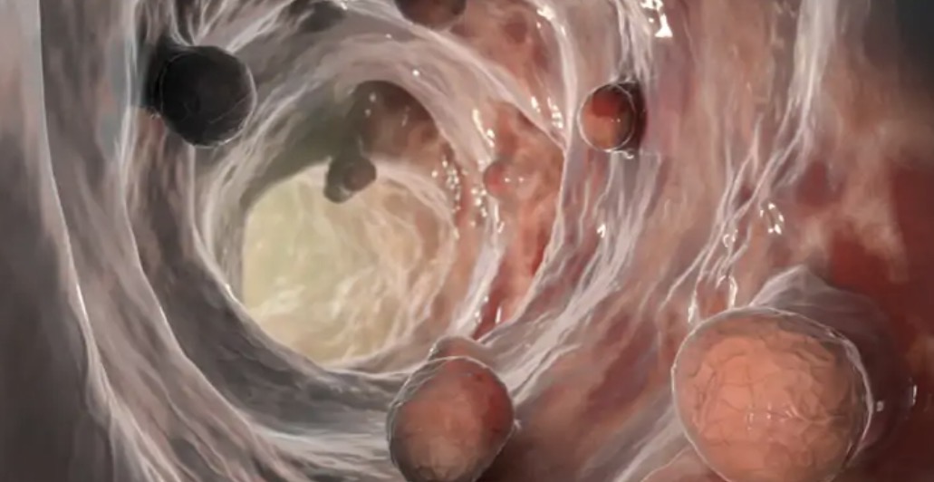 نصائح هامة للوقاية من سرطان الأمعاء